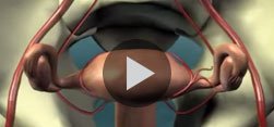 Animation featuring Embolization