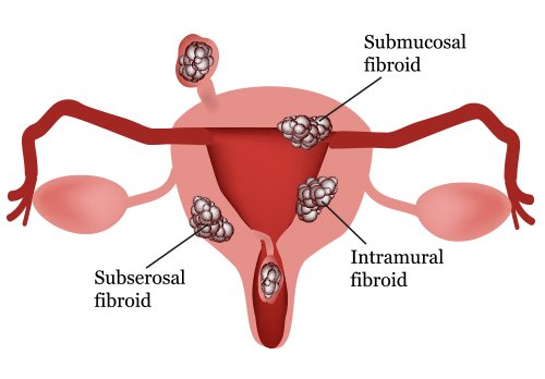 fibroid treatment for different types of uterine fibroids fibroid treatment for different types of uterine fibroids