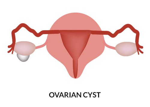 Ovarian Cysts Cause Enlarged Uterus Ovarian Cysts Cause Enlarged Uterus